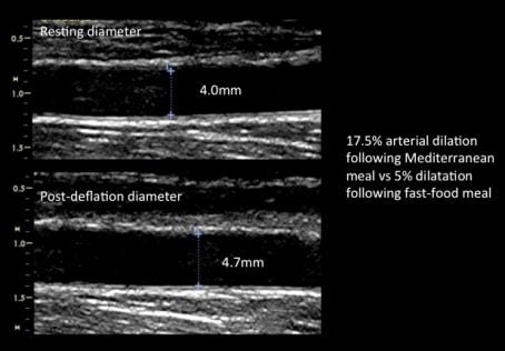 Effect of a single meal high in saturated fats on arterial dilatation Effect of a single meal high in saturated fats on arterial dilatation