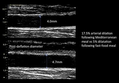 Effect of a single meal high in saturated fats on arterial dilatation